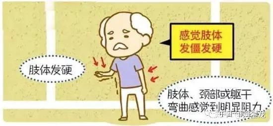 肌强直