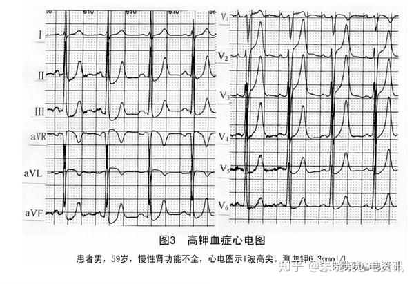 如血钠或血钙过低可加重血钾过高引起的心电图改变,而血