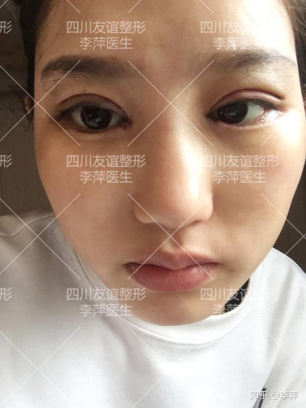内眦赘皮 患者诉求:希望眼睛能放大一点害怕术后太网红,太宽不自然的