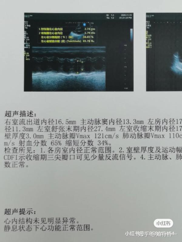 早产新生儿心脏彩超异常如何标体承保?