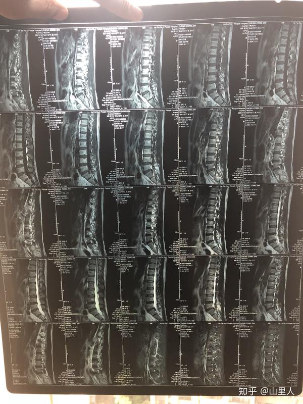 腰椎间盘脱出是保守治疗还是手术?