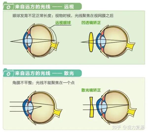 近视远视散光到底是怎么回事