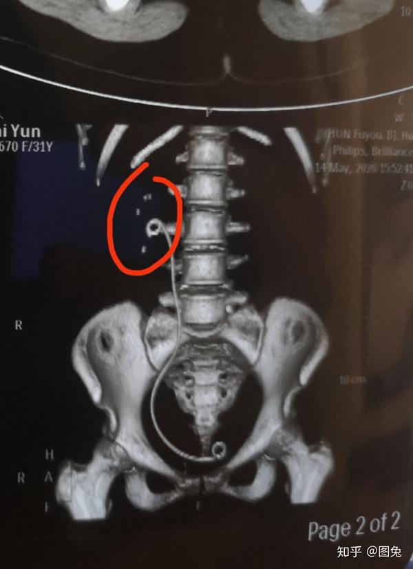 肾结石钬激光碎石和取双j管的经历