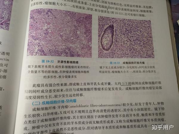 大家应该都知道,恶性肿瘤病理的主要特点就是细胞异型性和异常核分裂