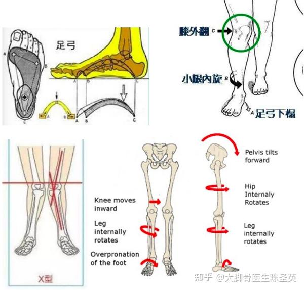 大脚骨女孩的夏日苦恼你有吗