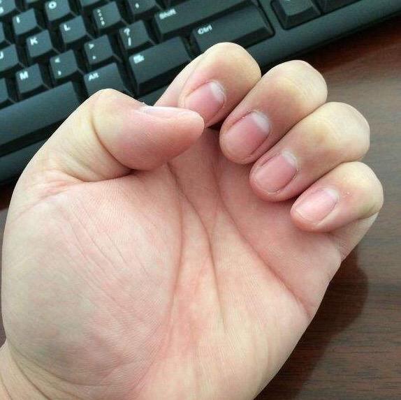 指甲的月牙儿和出现白点是咋回事儿缺乏维生素