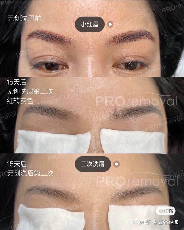 传统激光洗眉,皮秒洗眉是通过皮肤爆破结痂来达到褪色效果,一个是很