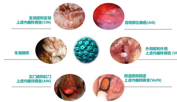 hpv疫苗接种与宫颈癌防治策略