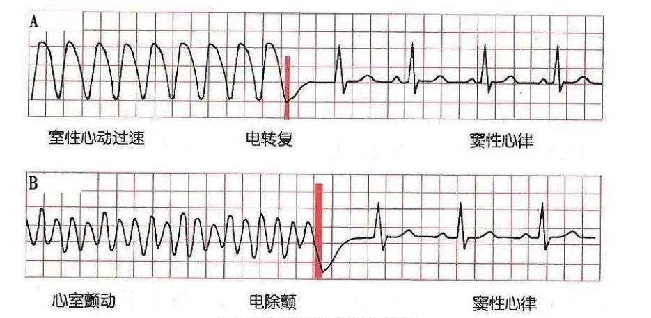 识别致命的心电图