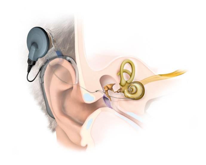 人工耳蜗能使用多少年