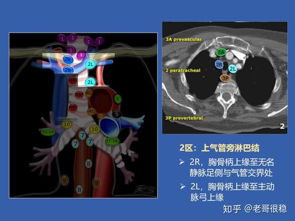 纵隔淋巴结分区与引流途径