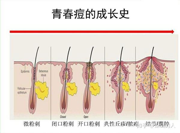 青春的痛——痤疮(青春痘)