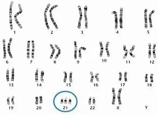 21-三体综合征的染色体组.