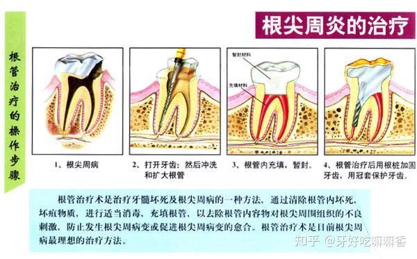 牙齿内部有牙髓,也就是牙神经,而根管治疗就是治疗牙髓和根尖病变的