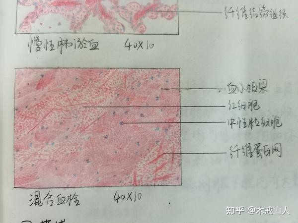 混合血栓 炎细胞 结核结节(部分) 高分化鳞癌 风湿性心肌炎 大叶性