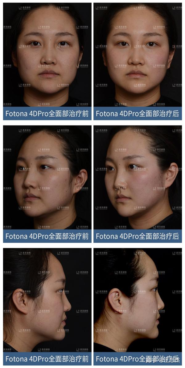 同为抗衰神器fotona4dpro和热玛吉到底该如何选择