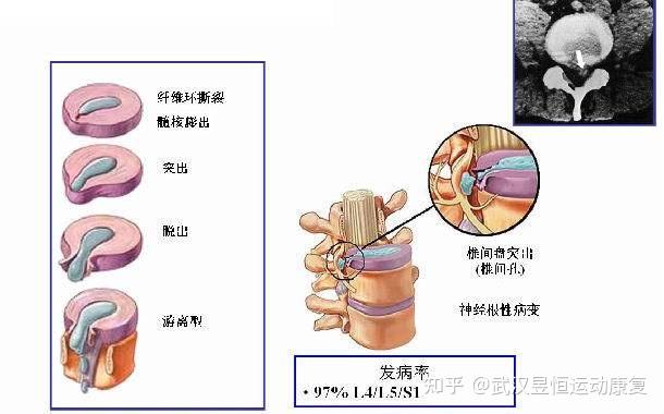 腰椎间盘突出有几个分型,膨出,突出,脱出,游离.