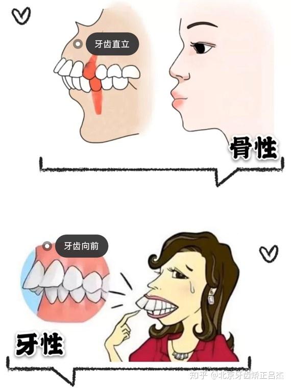 不同类型,不同程度的龅牙治疗方法也不相同:牙性龅牙,一般利用
