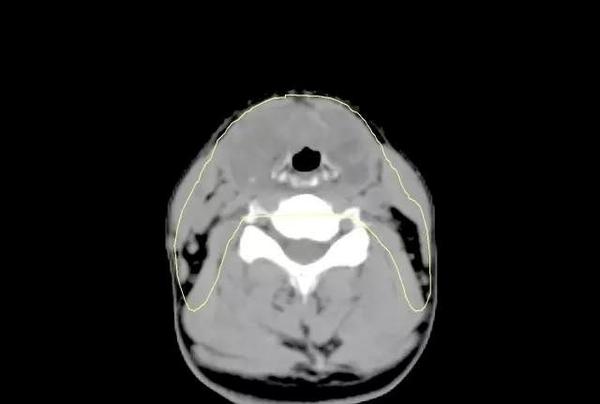 质子治疗喉癌的病例分析