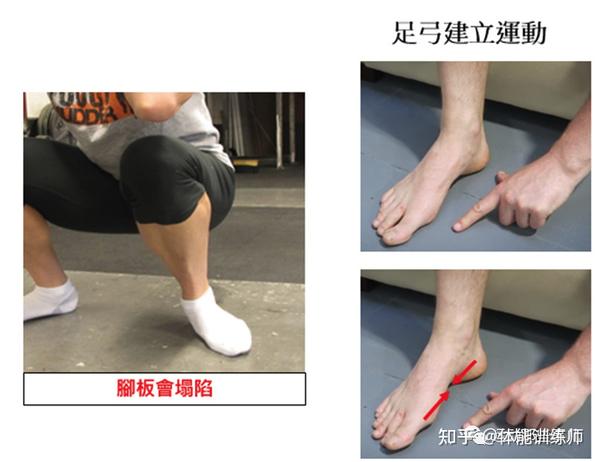 后天性的足弓塌陷. 什么是足弓塌陷?