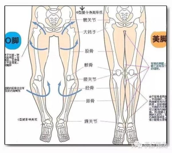 o型腿是, 股骨大转子外旋,股骨外旋,胫骨内旋.