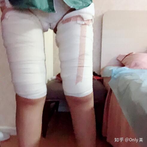 杭州公立医院医生做大腿环吸怎么样?效果好吗?