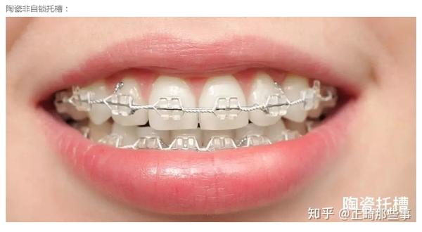 金属牙套和陶瓷牙套的区别 我们从图片上可以看出来,金属牙套的托槽