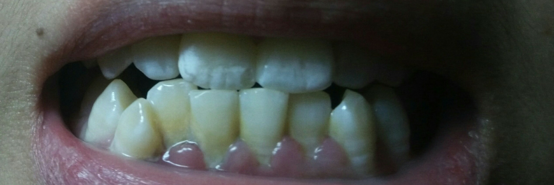 如何让牙齿变白呢? - 牙齿美白