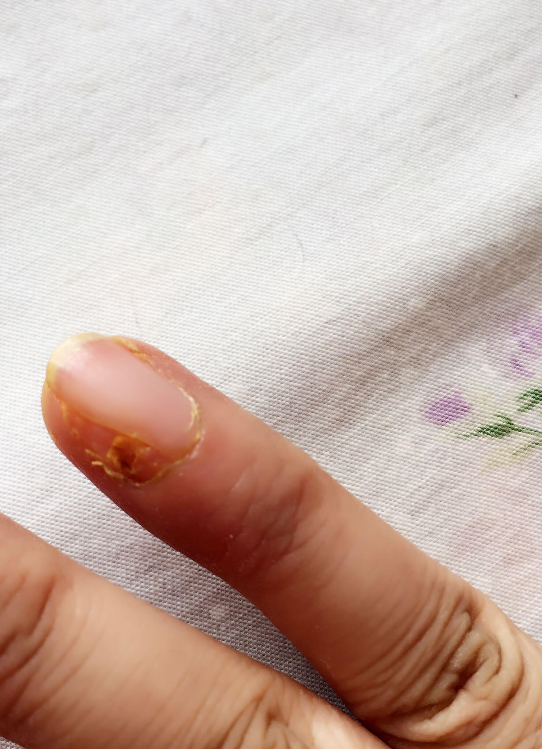 拔指甲是什么样的体验?很疼么? - 秦朗偶吧的回