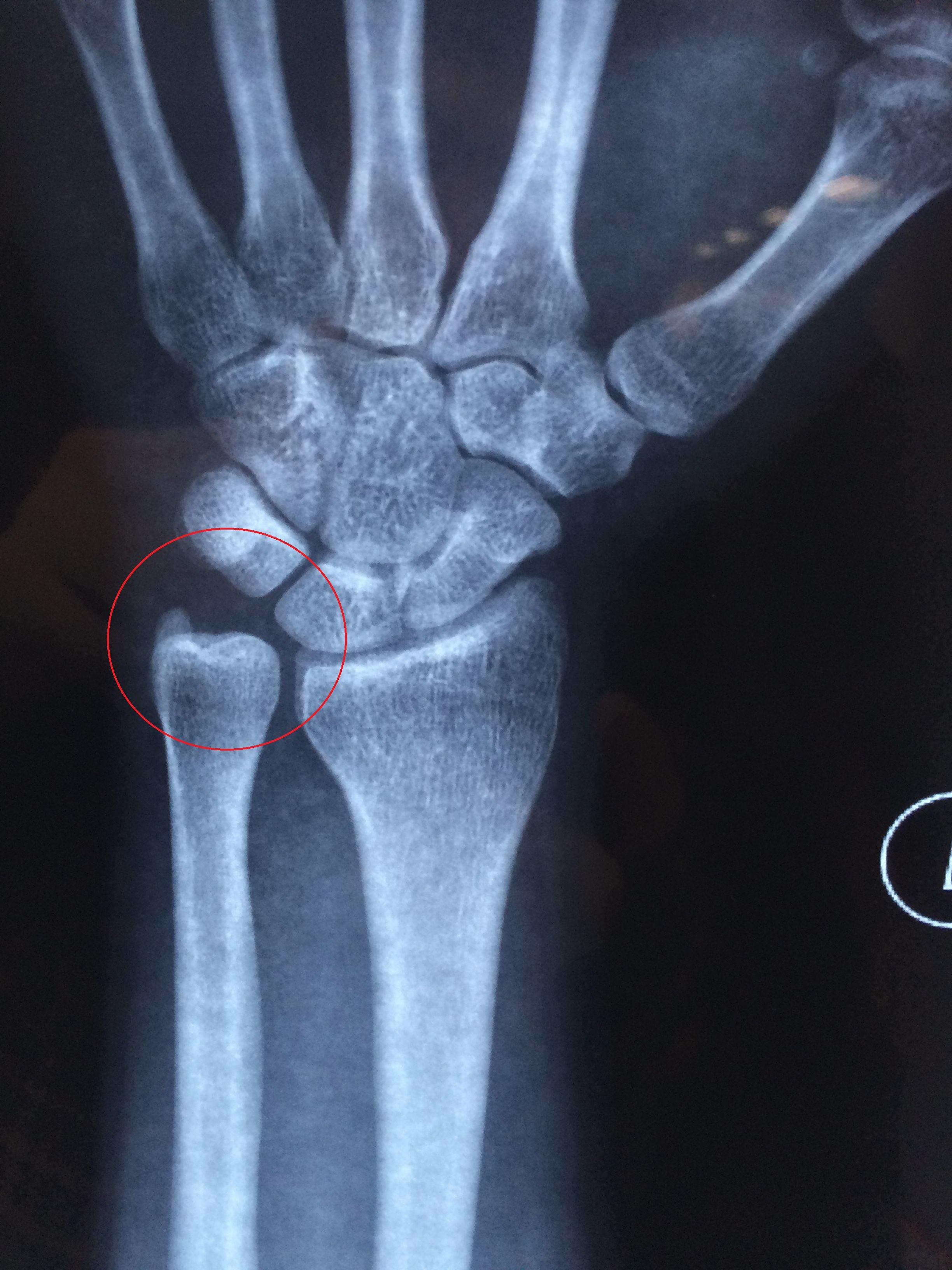 帮忙看看左手腕运动损伤x光图,是否是很严重的伤?