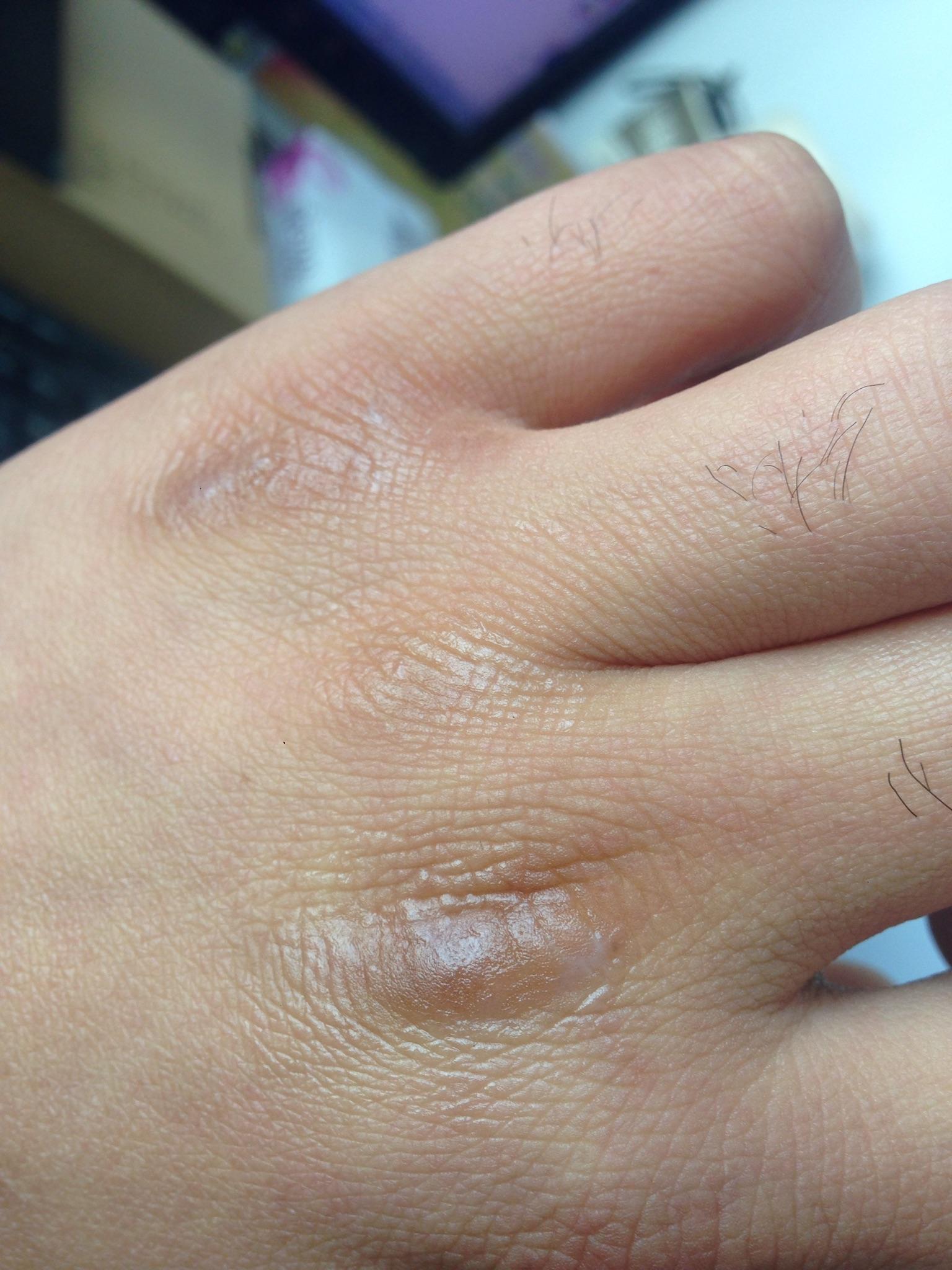 如何才能缓解手上皮肤的角质化,扒皮,增厚? - 知乎