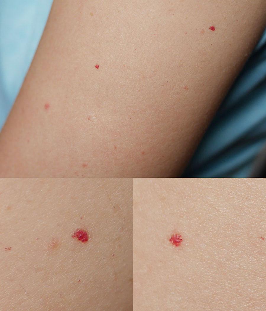皮肤有许多红色血点请问这是什么病需要治疗吗