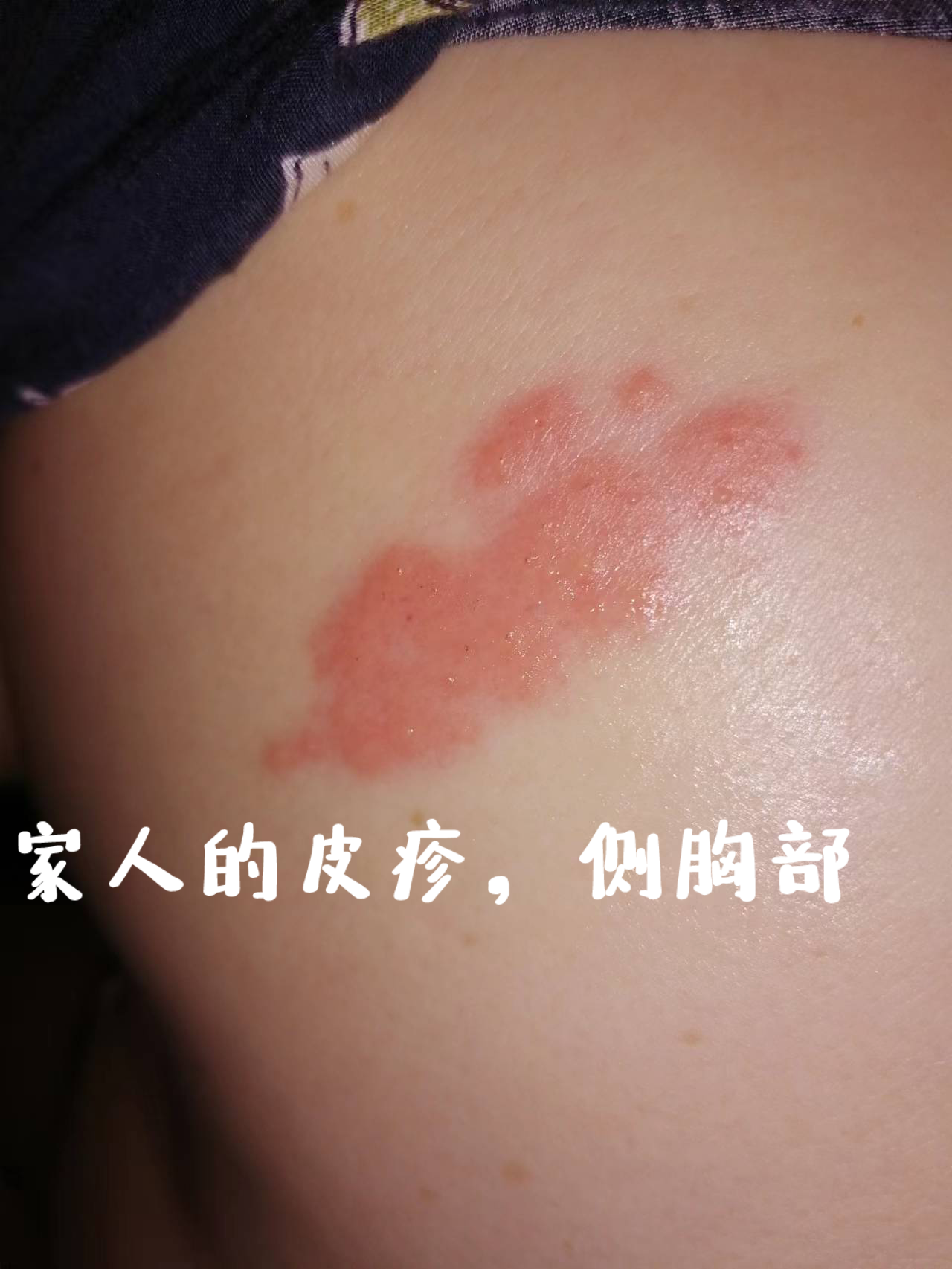 希哥儿 的想法: 带状疱疹