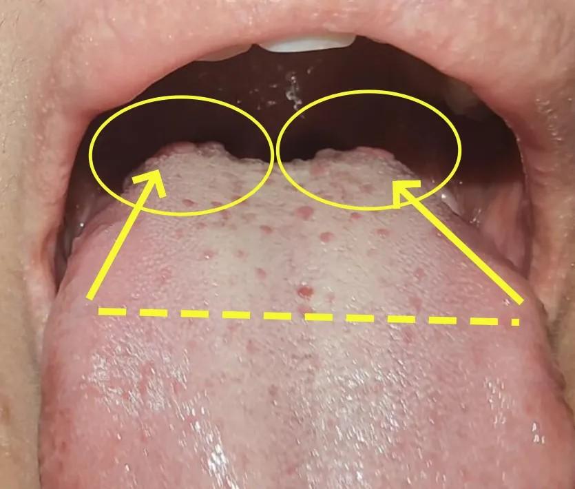 看看这个舌头,最典型的男科障碍的舌象