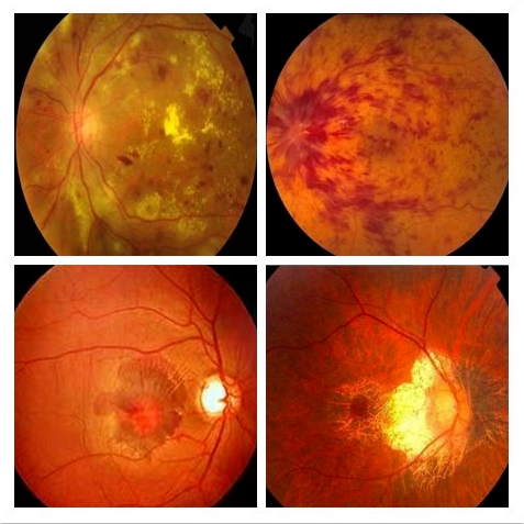 眼底出血会有哪些表现眼底出血不是一种单独的疾病而是多种眼部疾病和