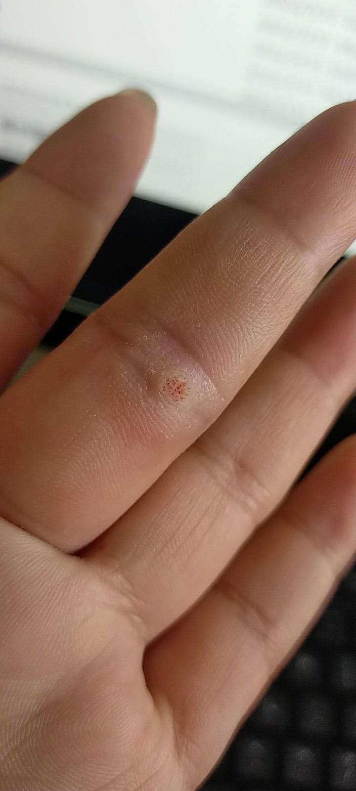 腰缠万贯 的想法: 手上这个东西本来是个黄色的有点透明的硬疙瘩,我给