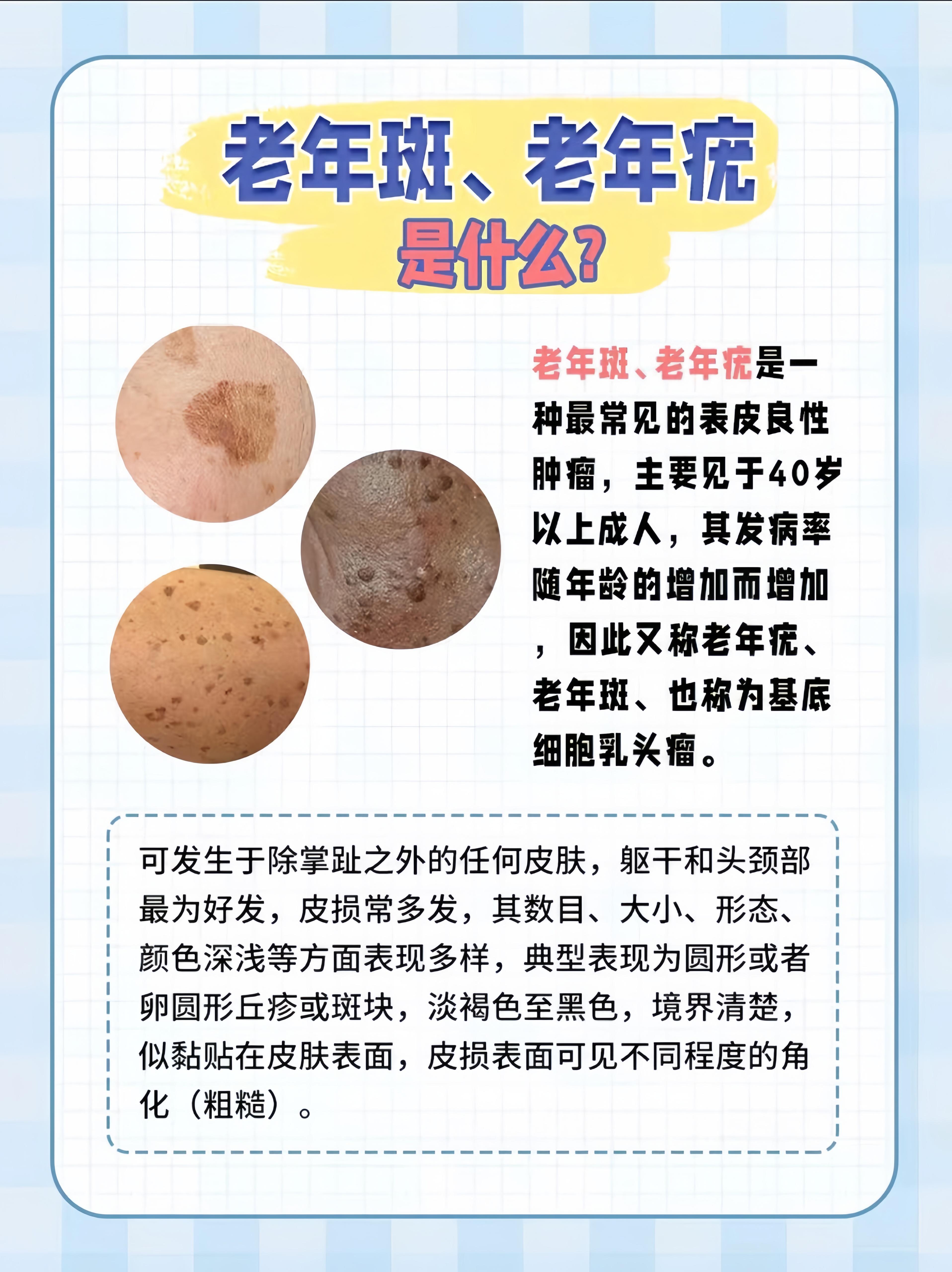 原上海九院王海珍医生 的想法: 一篇教你分清老年斑和老年疣❗️