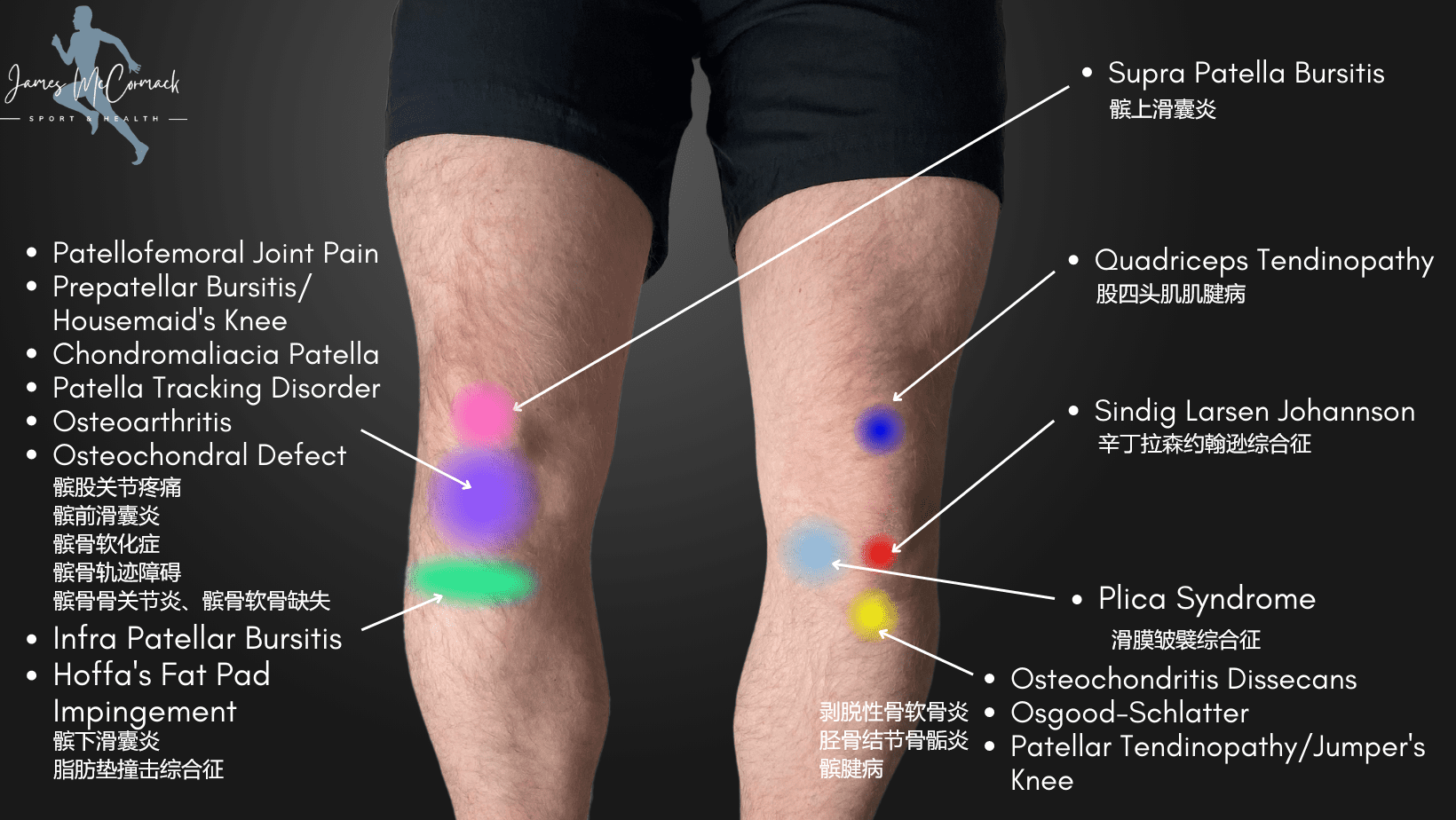:髌上滑囊炎2.髌骨上极