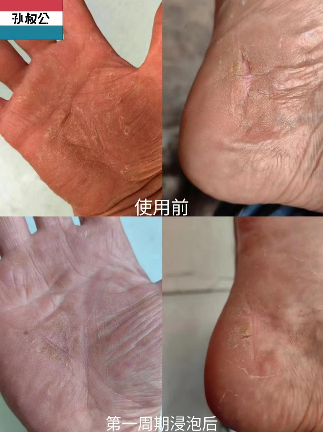 手癣脚气合并感染手足癣的致病菌具有同源性大部分都是嗜角质的丝状