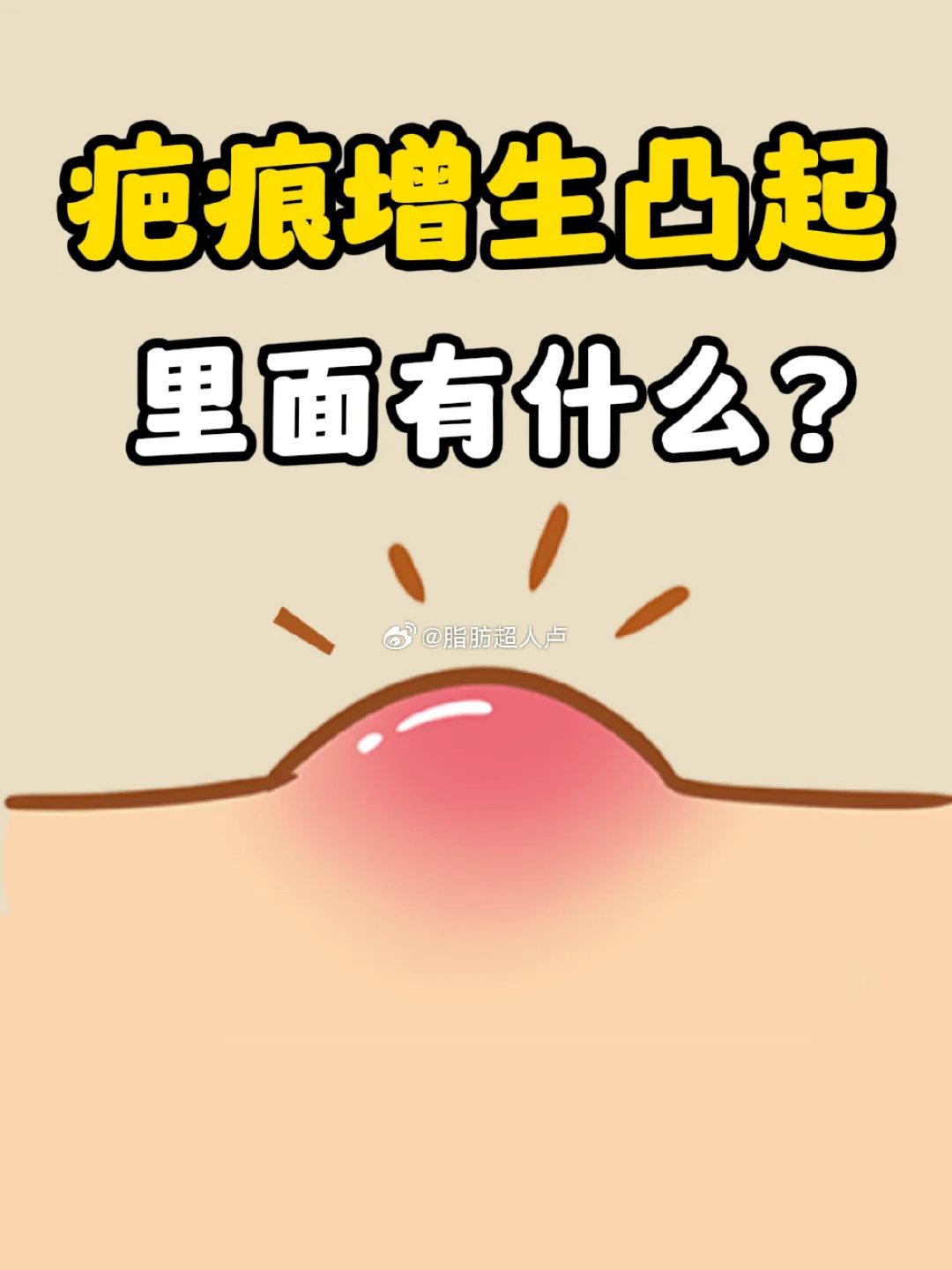 疤痕增生可以不管它吗为什么在线 疤痕增生可以不管它吗为什么在线