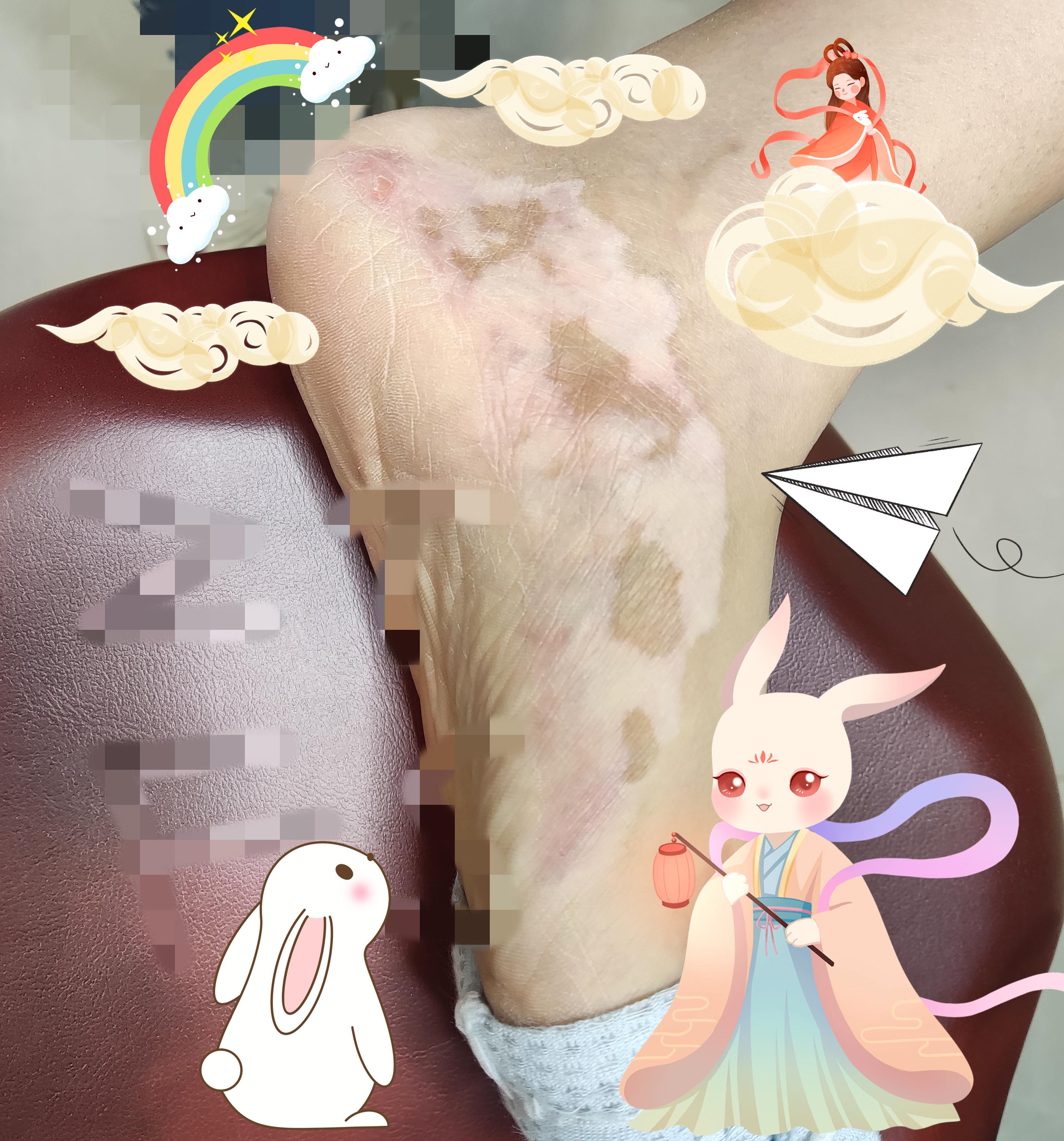 植泰肤色植色纹身 的想法: 肤色植色纹身遮盖白癜风,为什么有些不留色