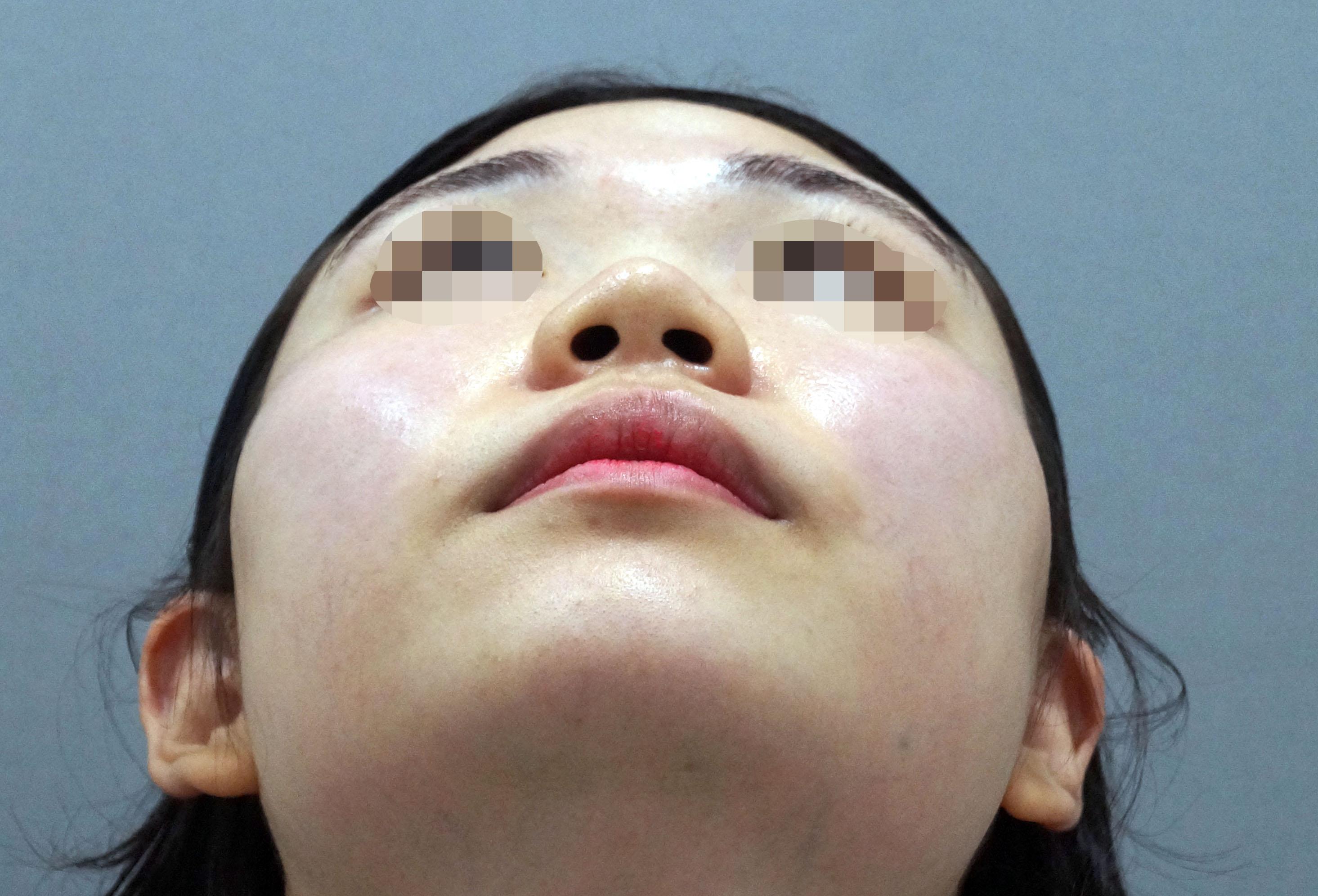 肉肉的真的是一种烦恼,就是大家平时所说的蒜头鼻吧,显得鼻头特别大