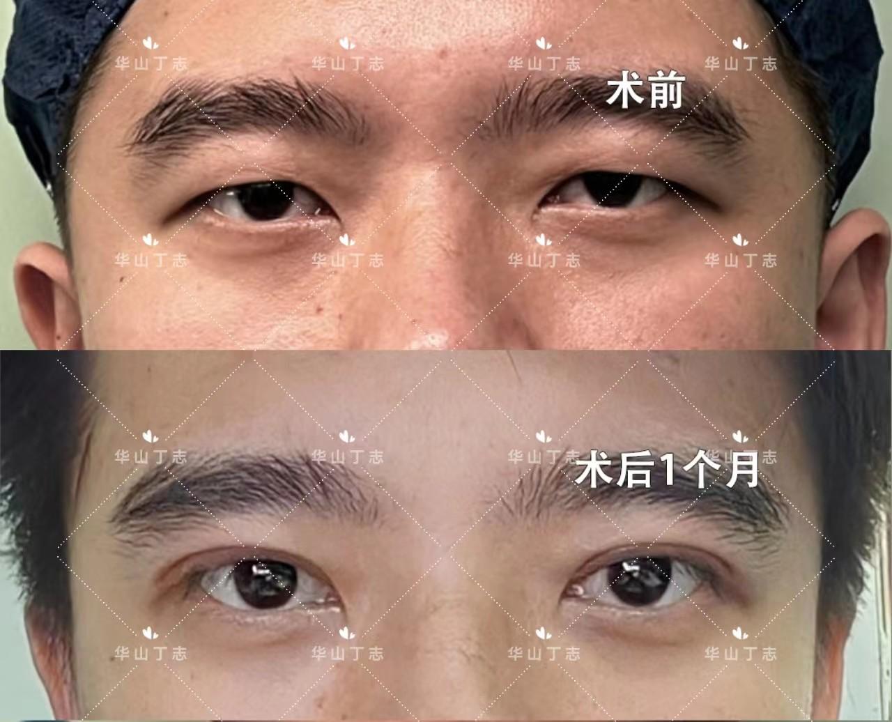 男双眼皮照片图片