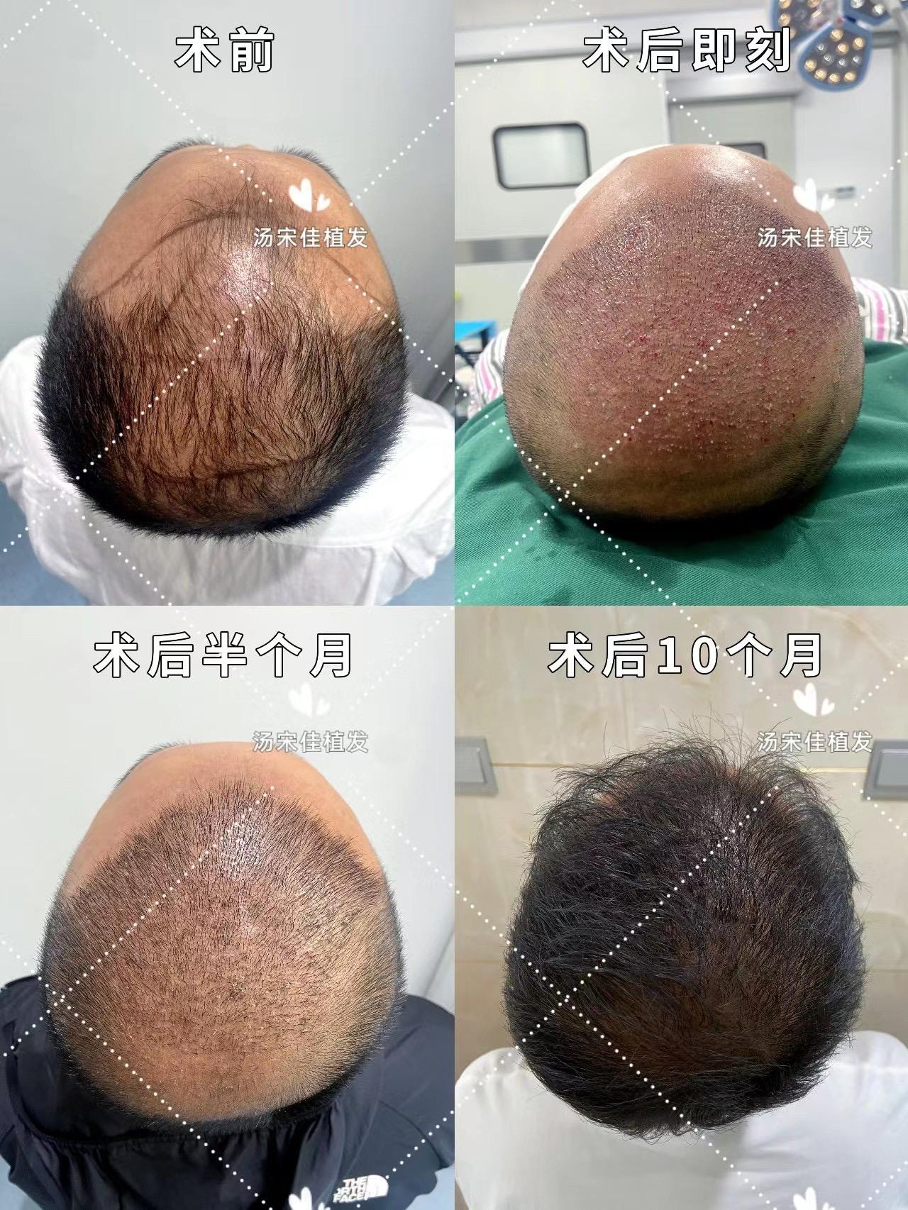 头顶生意植发(头顶植发怎么样)