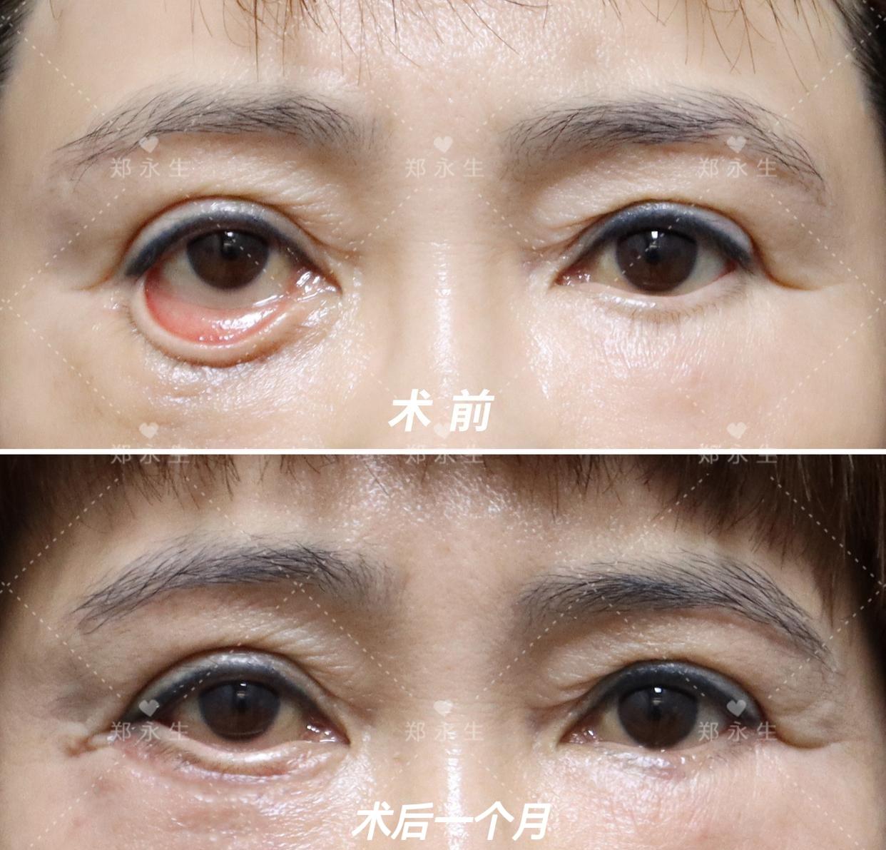 整形医生郑永生 的想法: 下睑外翻矫正后护理指南,做好了事半功倍!