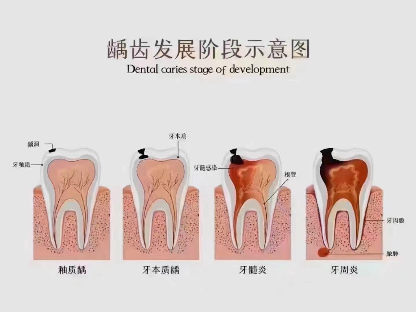 billy 的想法: 龋齿发展阶段示意图 <a class="hash_tag" href="