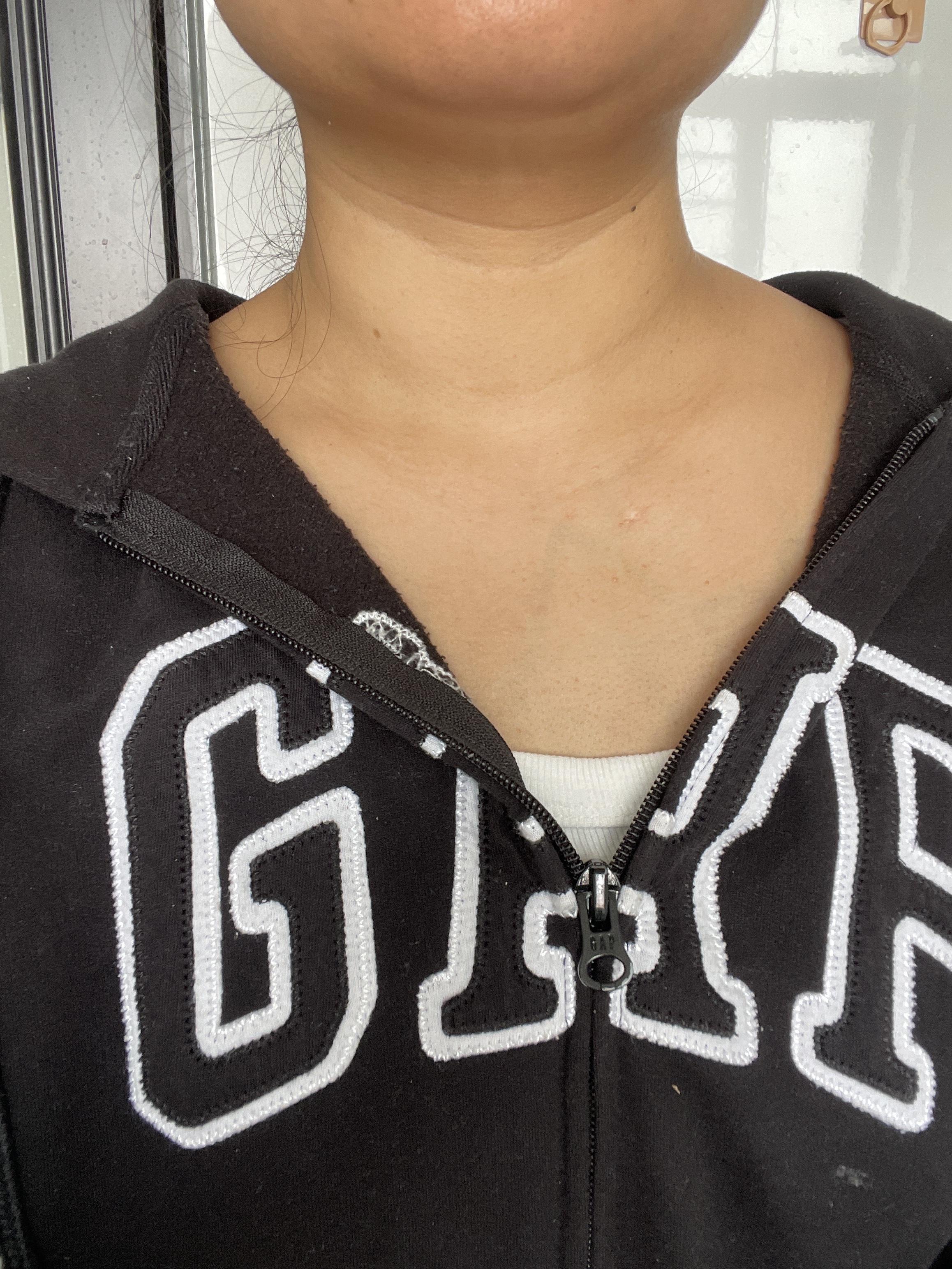 哈喽哈喽 的想法: 脖子越快越肿,有消肿的好办法吗?