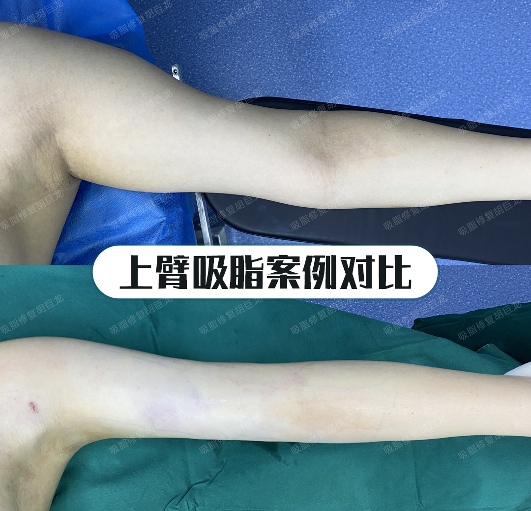 胡巨龙吸脂塑形 的想法: 手臂吸脂即刻案例对比