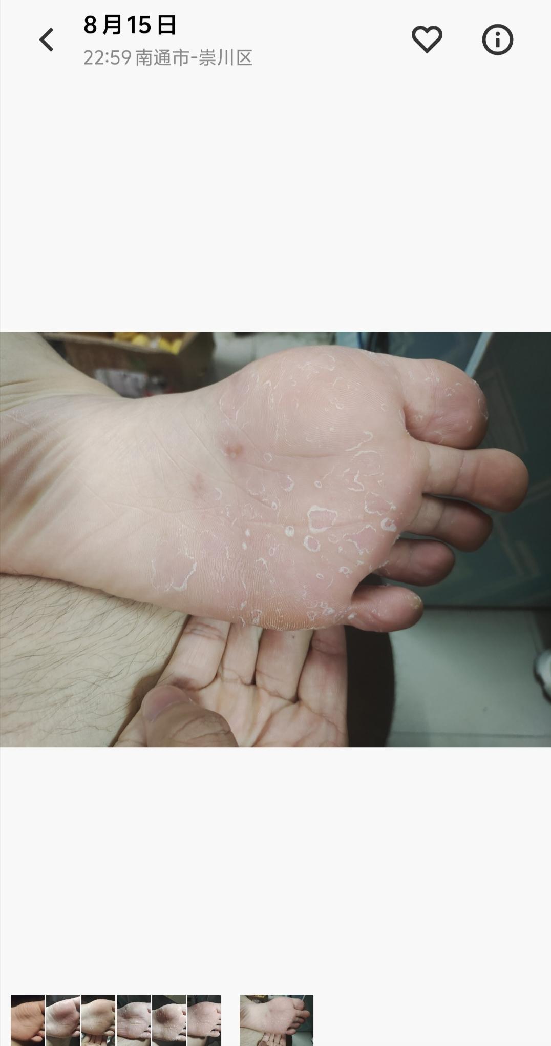 josephliao 的想法: 脚底脱皮的治疗过程