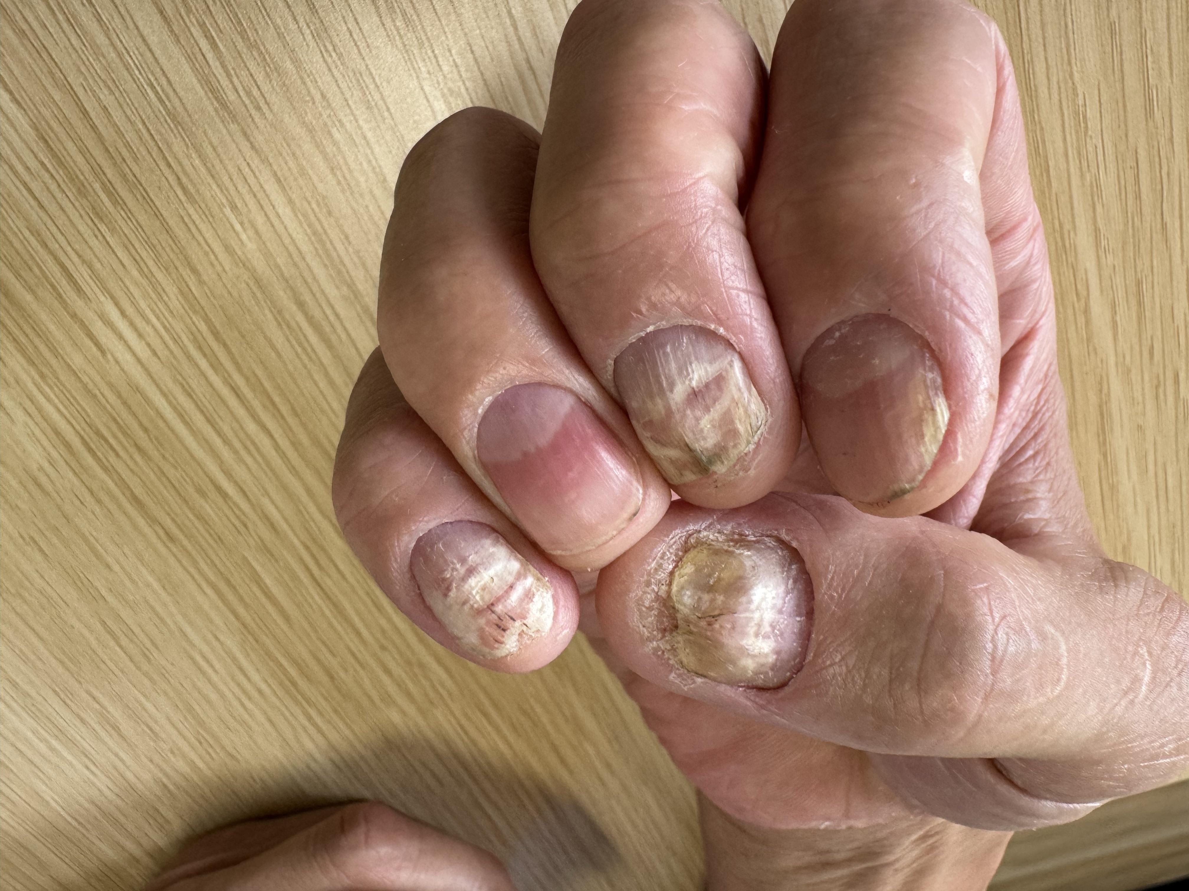 护肤在西塘 的想法: 灰指甲,都是真菌感染吗?